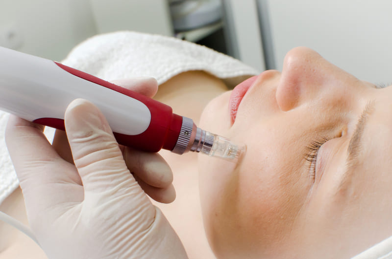 Dermapen funcionamiento - Saudabel Bienestar